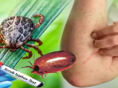 Scrub typhus in Odisha: Medical teams to be sent for surveillance in affected areas, says Health Minister scrub typhus in odisha