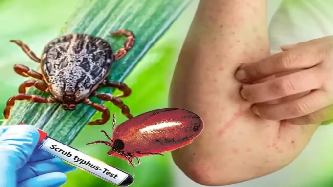scrub typhus in odisha scrub typhus in odisha